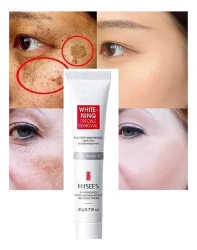 Creme Pomada Para Tirar Manchas Espinhas Melasma Acne Marca