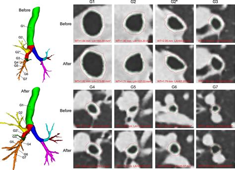 Quantitative CT Detects Changes In Airway Dimensions And Air Trapping