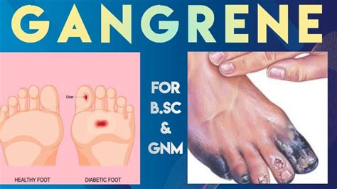 Gangrene Types Causes Symptoms Treatment Youtube