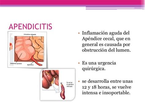 apendicitis