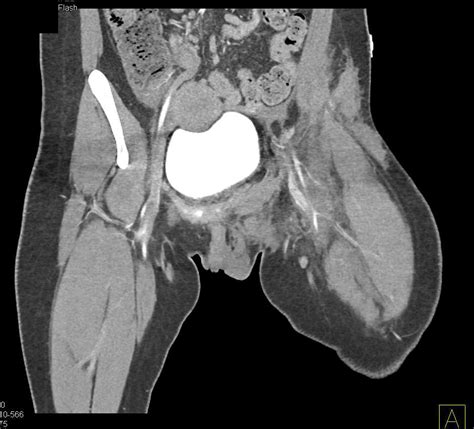 Complex Fracture Involving Left Acetabulum Femur And Si Joint Seen In 3d With Ct Cystogram