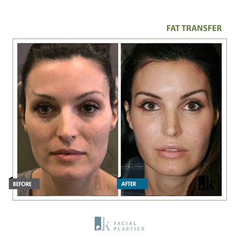 Fat Transfer John Kang Md F A C S Jk Facial Plastics Reconstructive