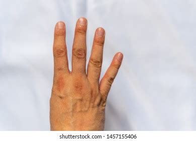 Close Secondary Stage Syphilis Sores Lesions Stock Photo 2430590873