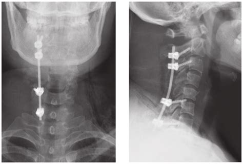 Post Operative Anteroposterior And Lateral Radiographs Download