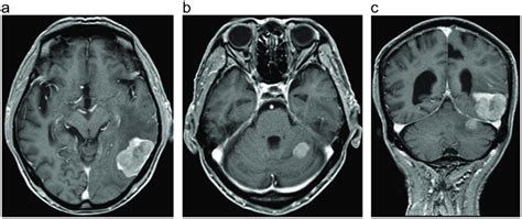 Gadolinium Enhanced Magnetic Resonance Imaging Fig 5a C Download Scientific Diagram