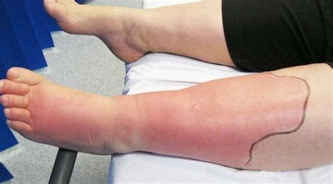 Cellulitis Symptoms Cnc Health Info