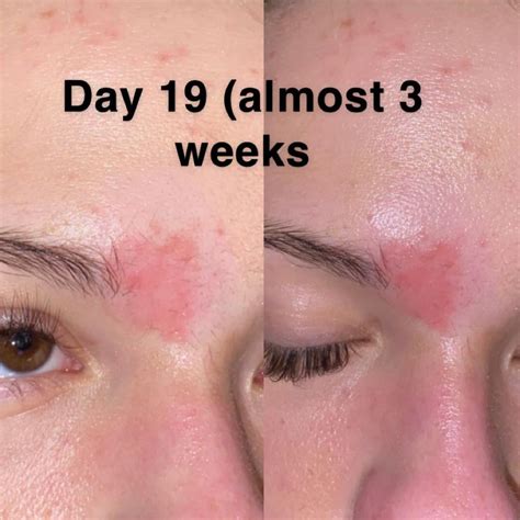 [acne] This Is My Chemical Burn After Almost 3 Weeks Please Click And Swipe On The Images To