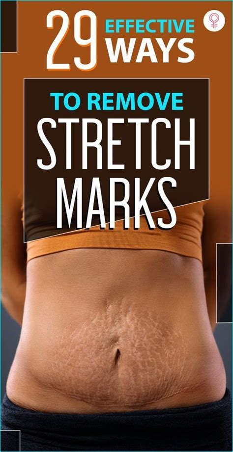 29 Effective Home Remedies To Reduce Stretch Marks Artofit