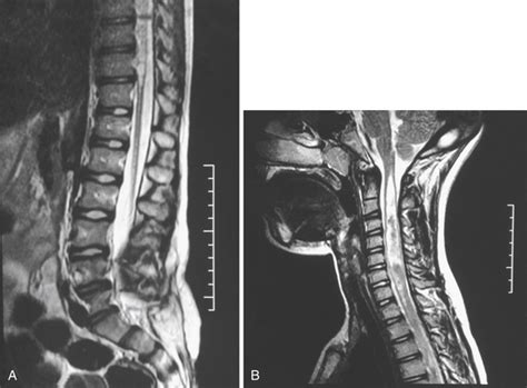 Syringomyelia | Neupsy Key