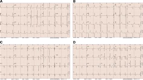 Cardiac Resynchronization Therapy Ecg