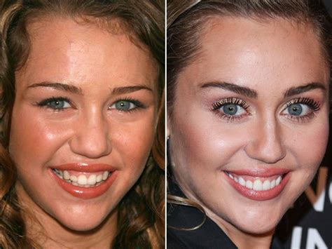 Miley Cyrus Teeth Before And After