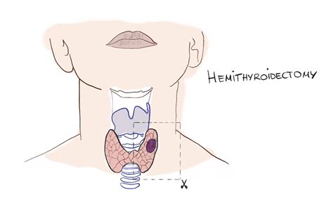 Thyroid Cancer: A Nodule That Should Worry You - Pro doctor