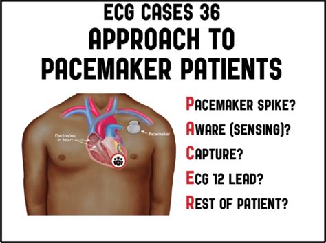 Pacer Mnemonic Approach To Pacemaker Patients Ecg Cases Em Cases