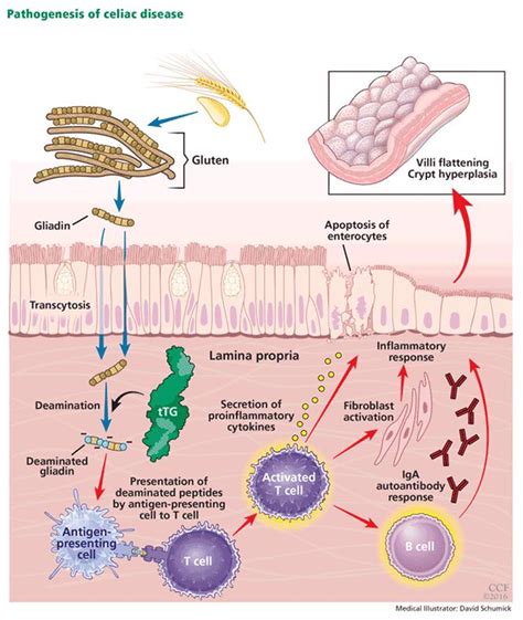 Celiac Disease Managing A Multisystem Disorder Cleveland Clinic Journal Of Medicine