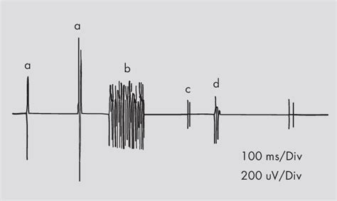 Needle Electromyography | Download Scientific Diagram