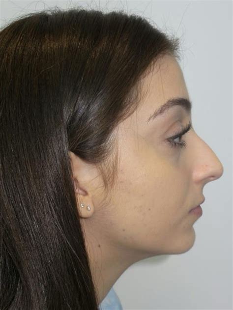 Rhinoplasty Before And After Grover Aesthetics