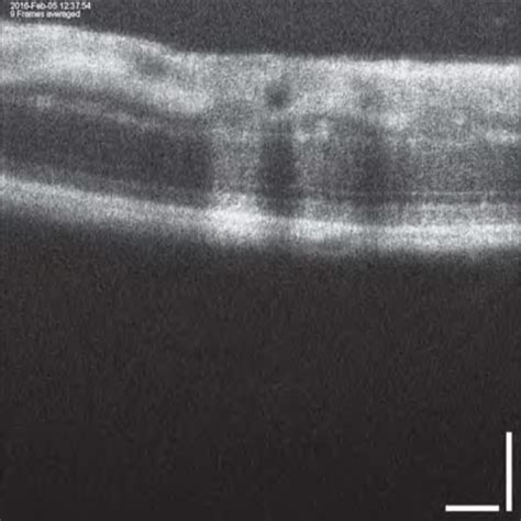 Fluorescein Angiogram And Corresponding Spectral Domain Optical Download Scientific Diagram