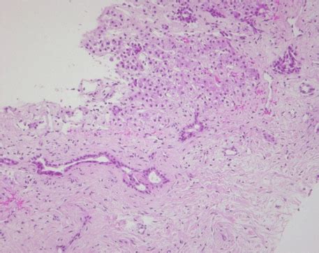 Full Text Mesenchymal Hepatic Hamartoma Associated With Elevated