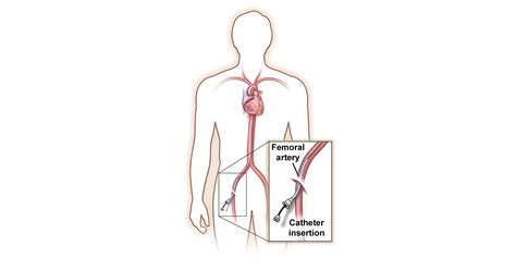 Angiograms And Angioplasty Using Your Bodys Vascular Highway To