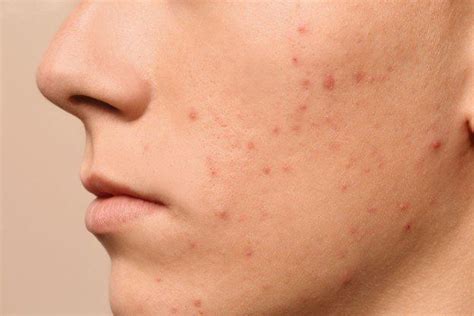 Acne Nodules On Face