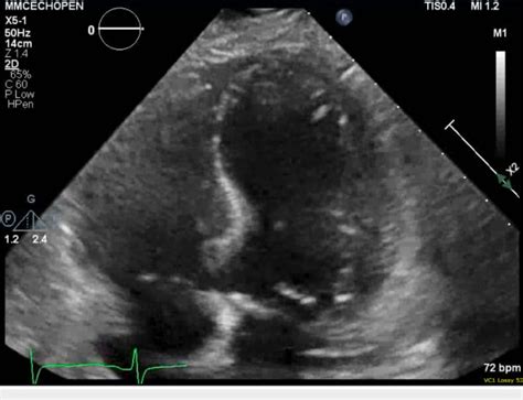 Transthoracic Echocardiogram Apical Four Chamber View Showing Left