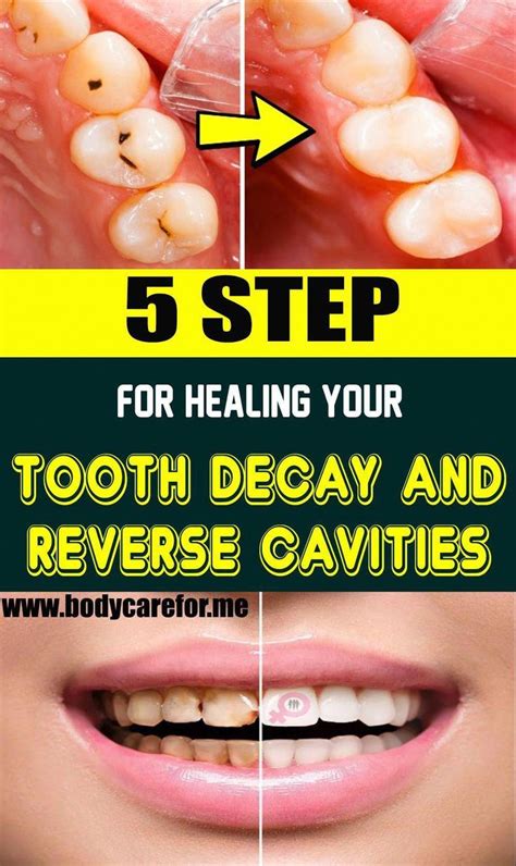 5 Steps For Healing Your Tooth Decay And Reverse Cavities Health