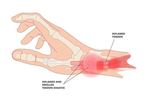 Pain At The Base Of Thumb Learn About De Quervains Tenosynovitis