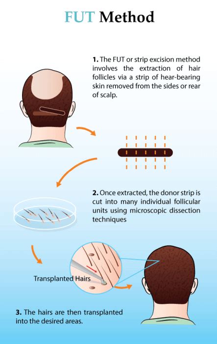 Korea Hair Transplant Center Fut Follicular Unit Transplant