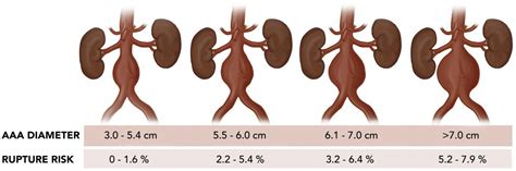 Society For Vascular Surgery Implementation Of Guidelines In Abdominal Aortic Aneurysms