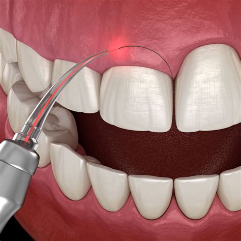 Frenectomy Camp Smile