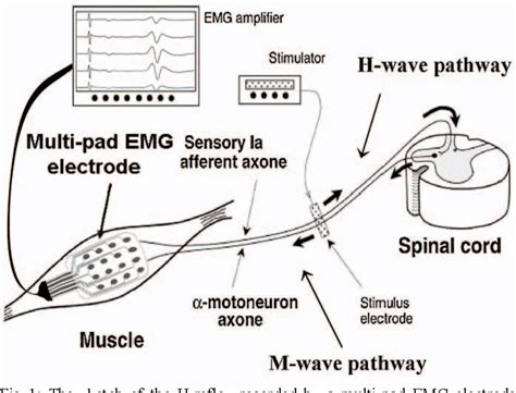 figure    reflex recorded  multi pad emg electrodes semantic