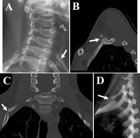 Case 1 A Plain Radiograph Oblique View Showing The Right Cervical Download Scientific