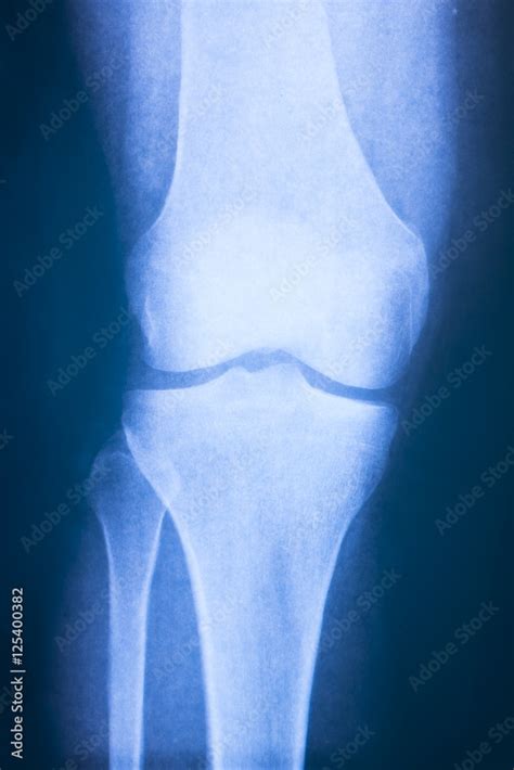 Knee x-ray. X-ray health care image. Stock Photo | Adobe Stock