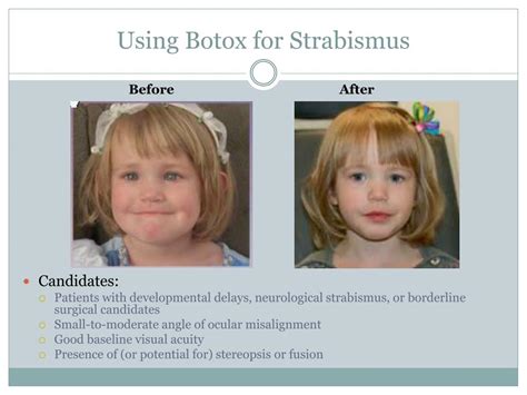 Ppt Strabismus What You Need To Ask And Know Powerpoint Presentation