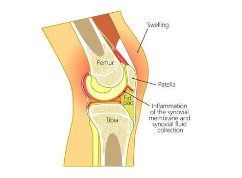 how to know if your knee is swollen