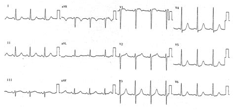 Electrocardiography Revealed A Normal Sinus Rhythm With Mild Stsegment