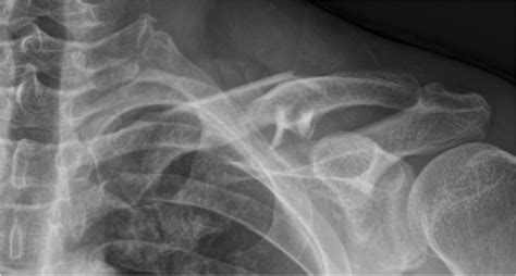 Comminuted Midshaft Left Clavicle Fracture Robinson Classification