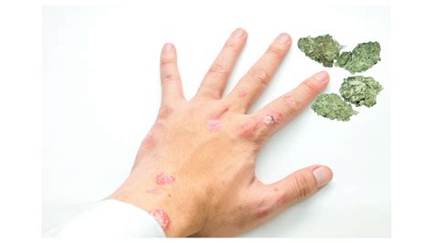 Come Curare La Psoriasi Con La Canapa Cbd Cannabidiolo