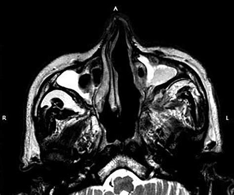 T2 Weighted Magnetic Resonance Imaging Of The Maxillary Sinuses Of A Download Scientific