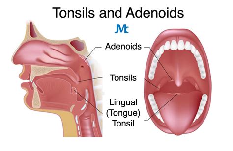 Tonsillectomy Procedure Step By Step