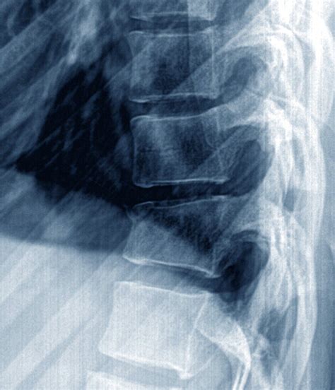 Thoracic Spine Fracture X Ray Bild Kaufen 13452143 Science Photo