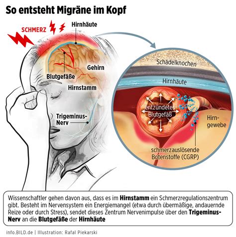 Schmerzmediziner kritisieren Migräne Millionen Patienten schlecht