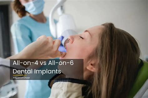 All On 4 Vs All On 6 Dental Implants Which Is Better