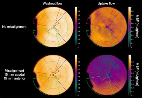 Effect Of 15 Mm PET CT Misalignment On Absolute MBF For Values Measured