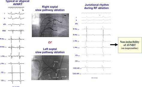 Endpoints For Successful Slow Pathway Catheter Ablation In Typical And