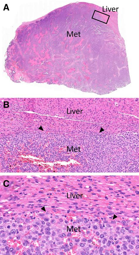 Pushing Histopathological Growth Pattern Hgp A Scanning Download Scientific Diagram