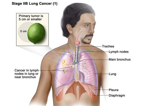 Nivolumab And Chemotherapy For Early Stage Lung Cancer Nci