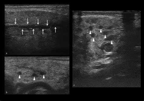 Fig 6 Different Examples Of Acute Sialadenitis In The Left Parotid