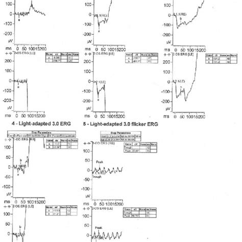 Visual Field Humphrey Campimetry In Both Eyes Showing Peripheral