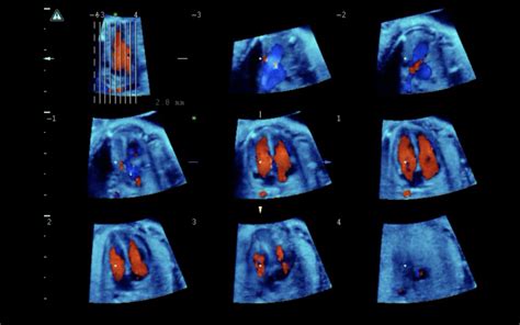 Curso Ecocardiografía fetal Fundación iMaterna